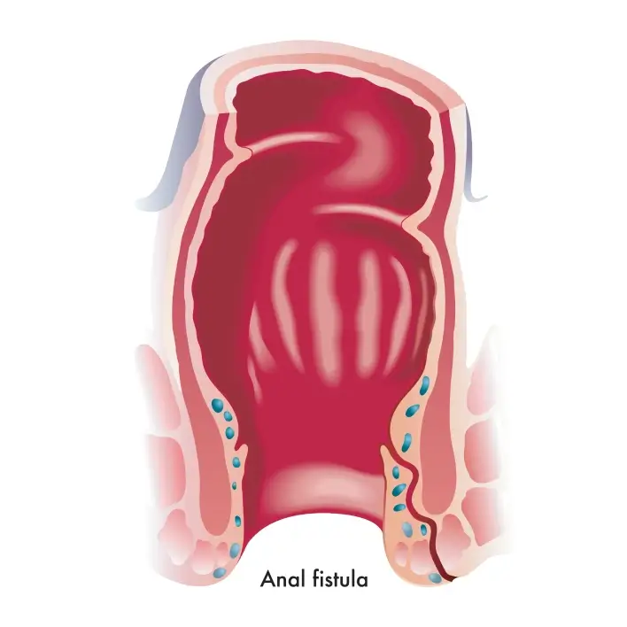 Anal fistula diagram illustration